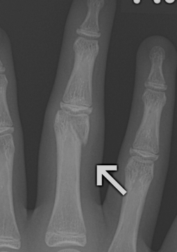 Finger Unicondylar Displaced Fracture
